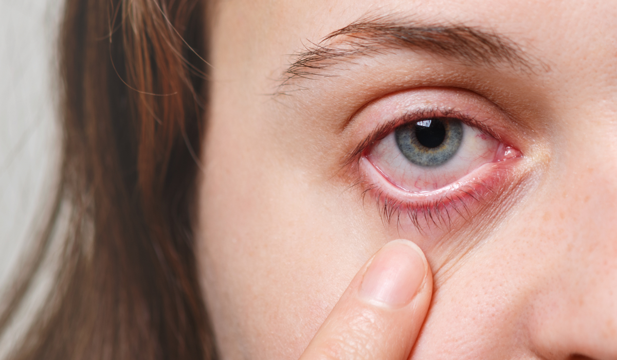 Fotoqueratitis, qué es, síntomas y tratamiento